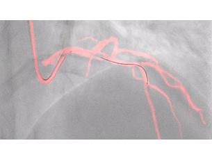 dynamic coronary