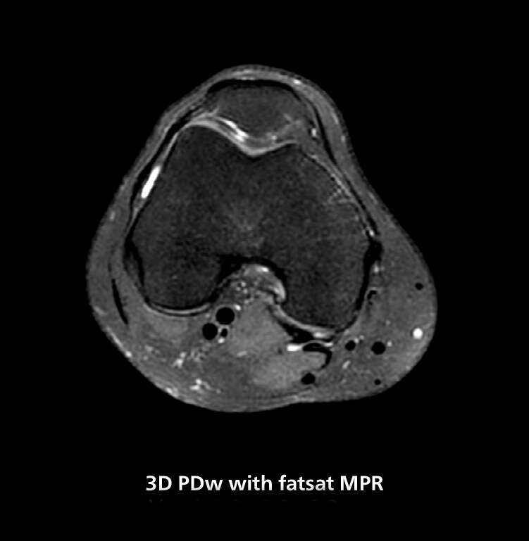 Knee MRI three