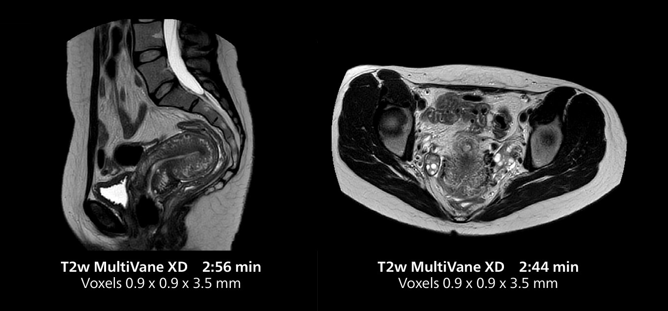 Pelvis MRI two