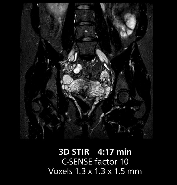 Pelvis MRI three