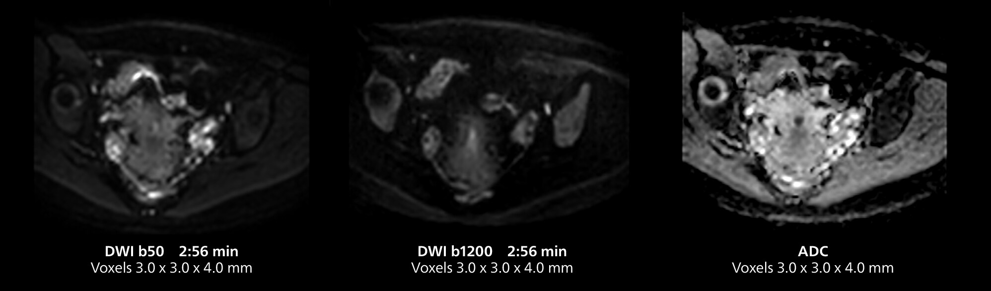 Pelvis MRI four