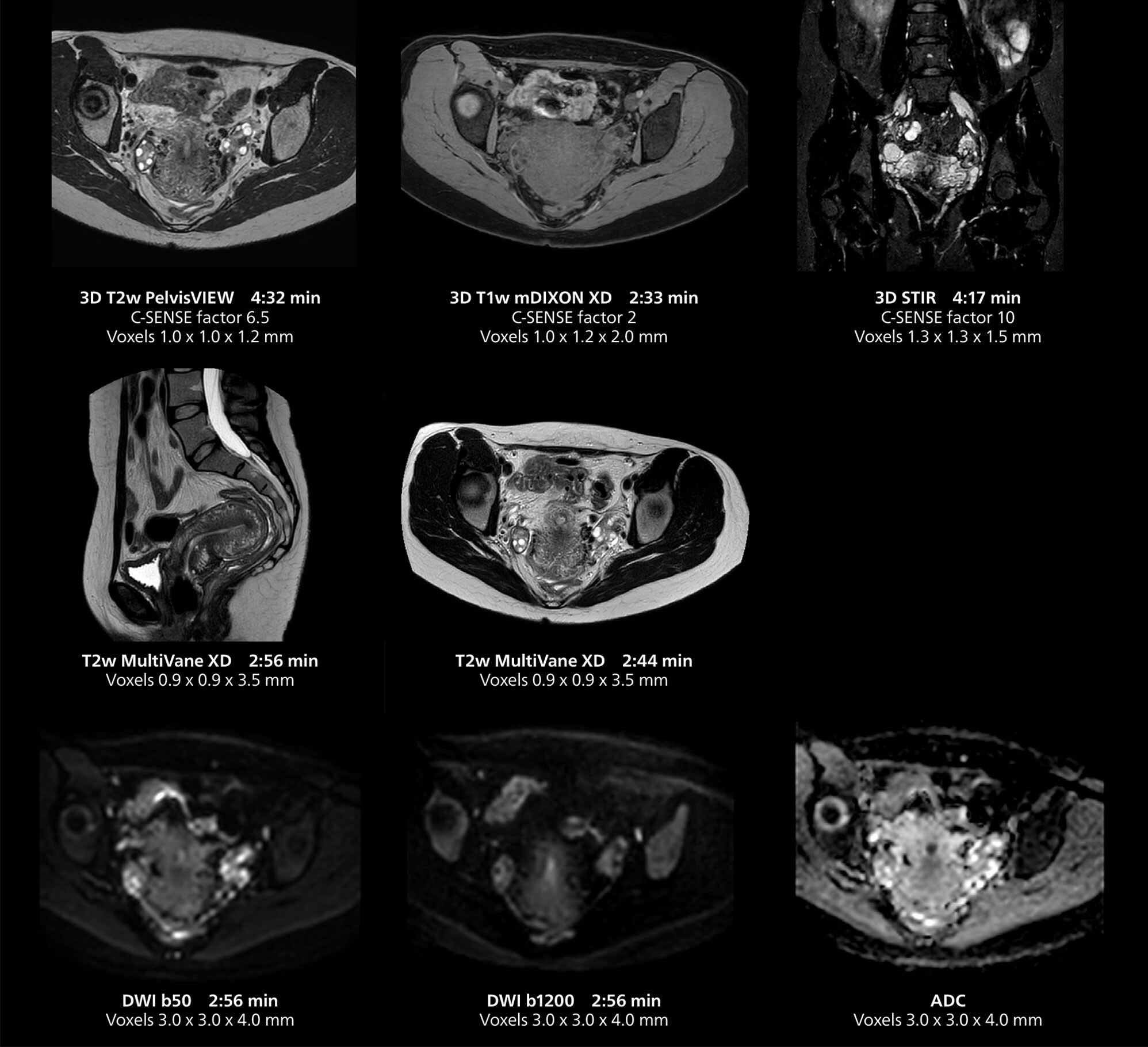 Female pelvis MRI