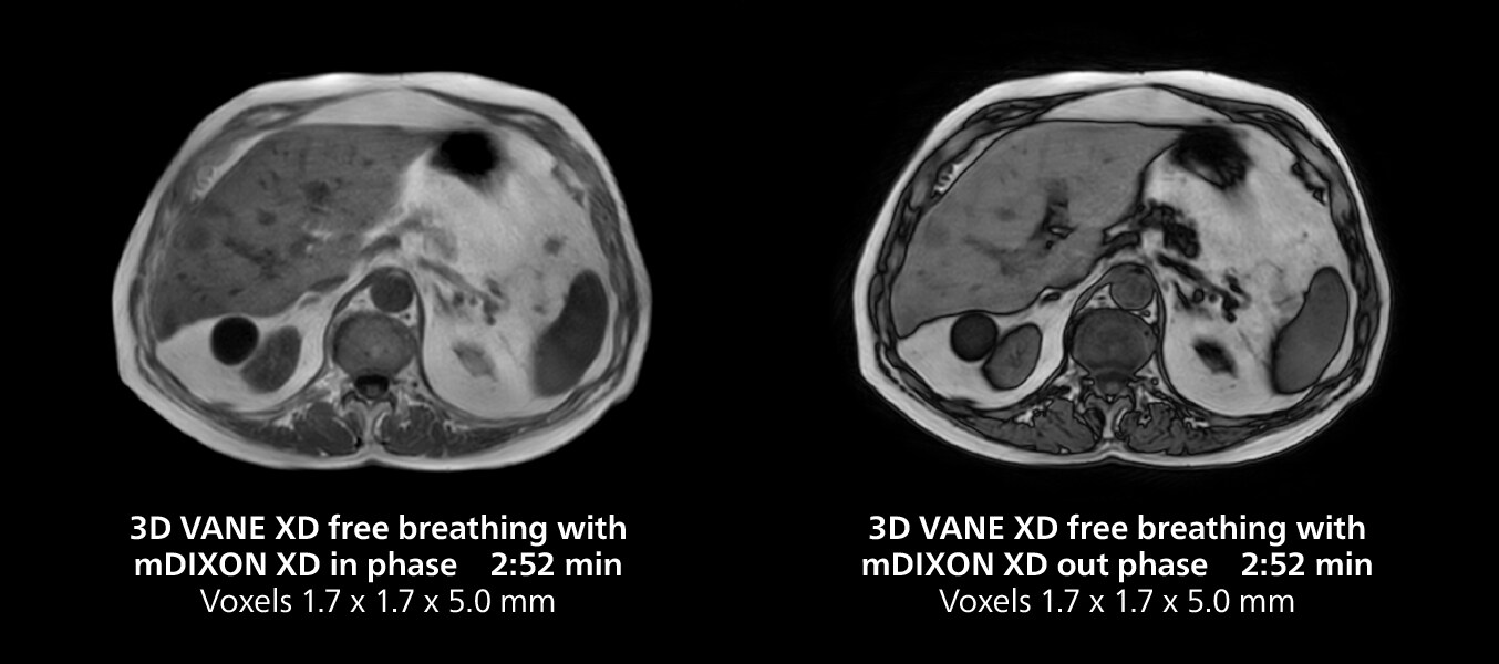 Liver MRI two