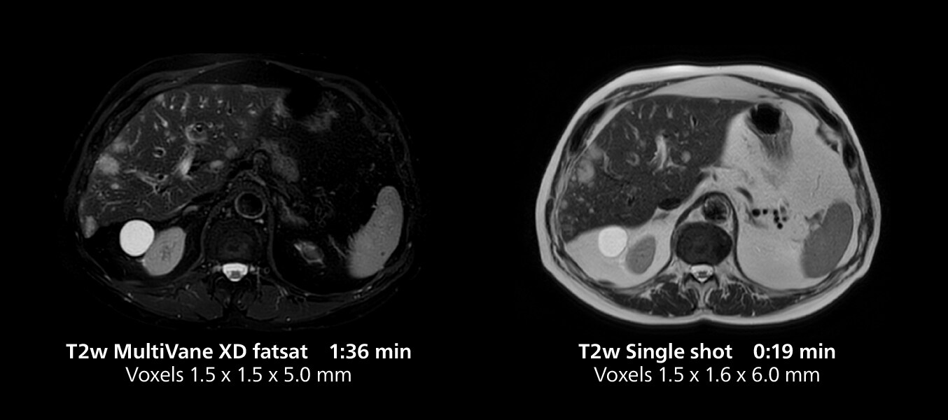 Liver MRI three