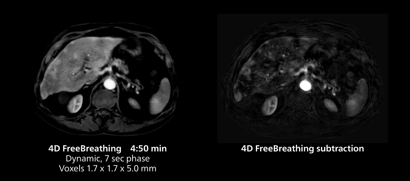 Liver MRI four