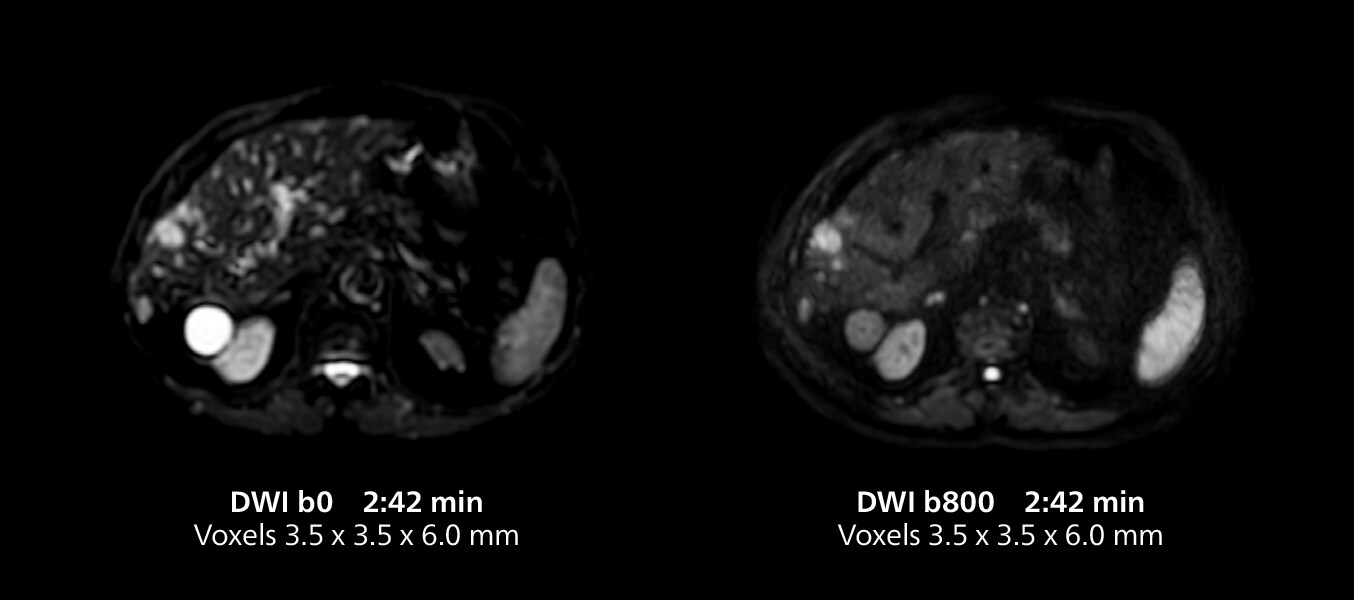 Liver MRI five