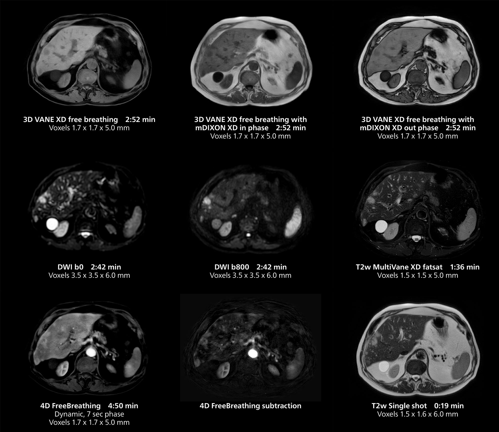 Liver MRI