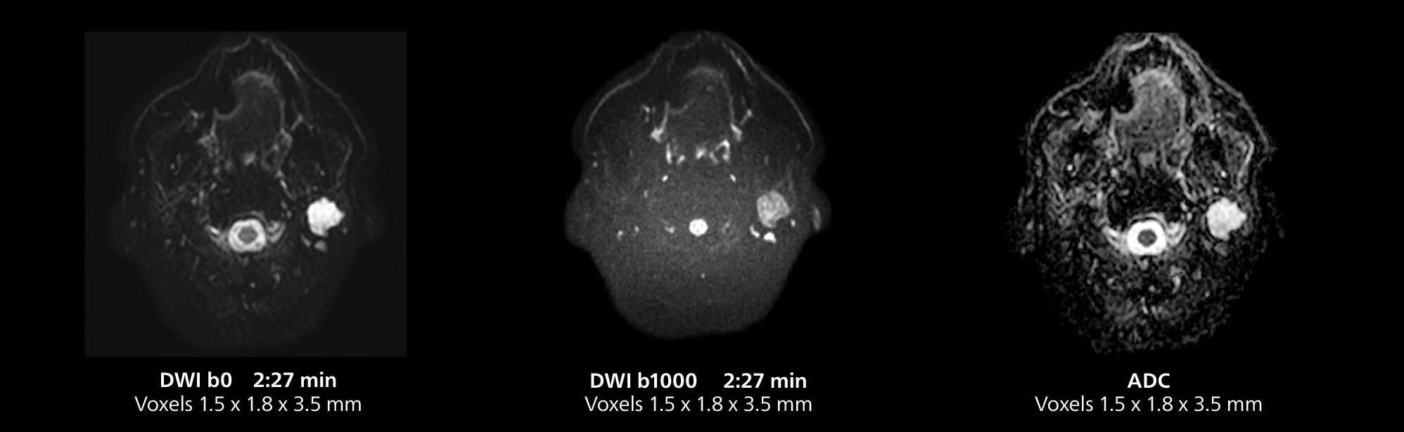 Salivary gland MRI four