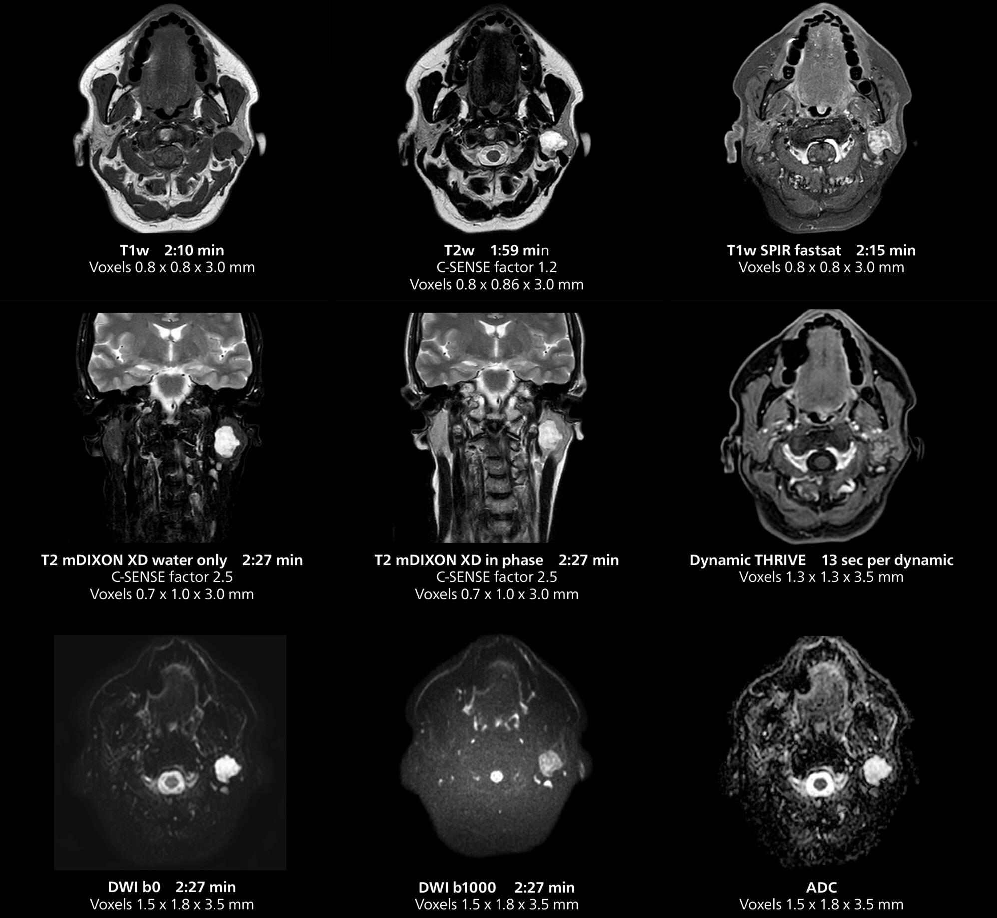 Salivary gland MRI