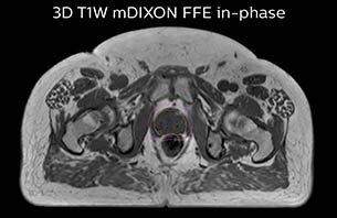 Turku MRI-T1W therapy case 1