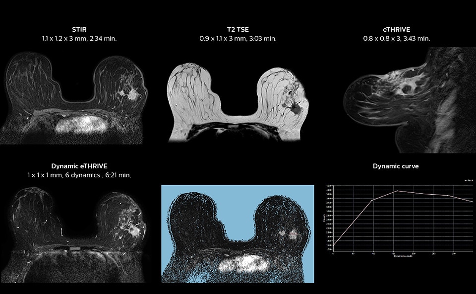 MRI of patient with invasive ductal carcinoma