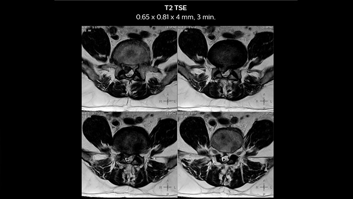 T2 TSE magnetic resonance imaging