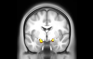 MultiBand SENSE fMRI faces vs places subcort coronal