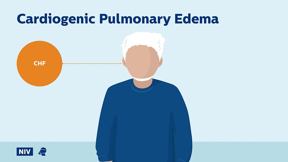 Cardiogenic Pulmonary Edema question video