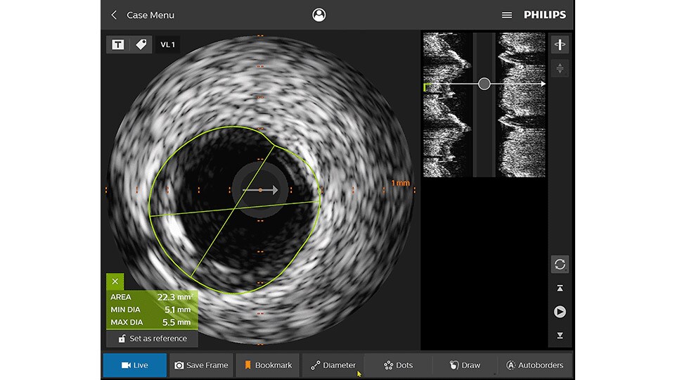 IVUS visuals