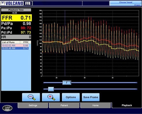 FFR image guided therapy