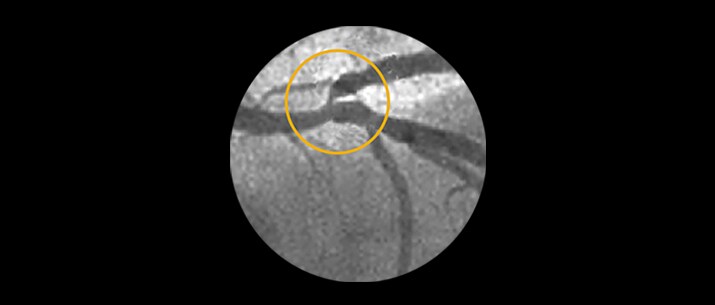 Clinical image of Ostial and bifurcation lesions