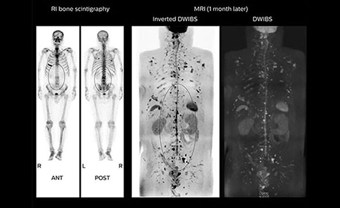 Whole body MRI