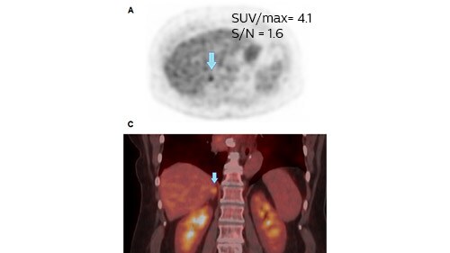 lung cancer image zwolle