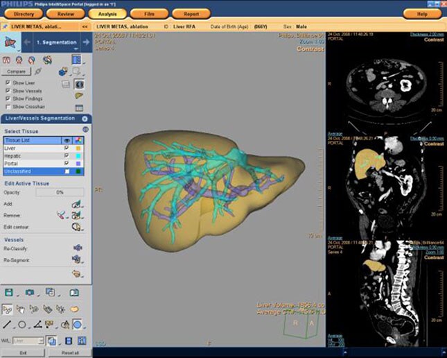 liver analysis